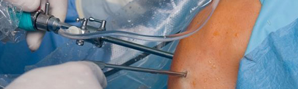 shoulder Arthroscopy